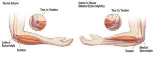 Golfers vs Tennis Elbow 300x113 1